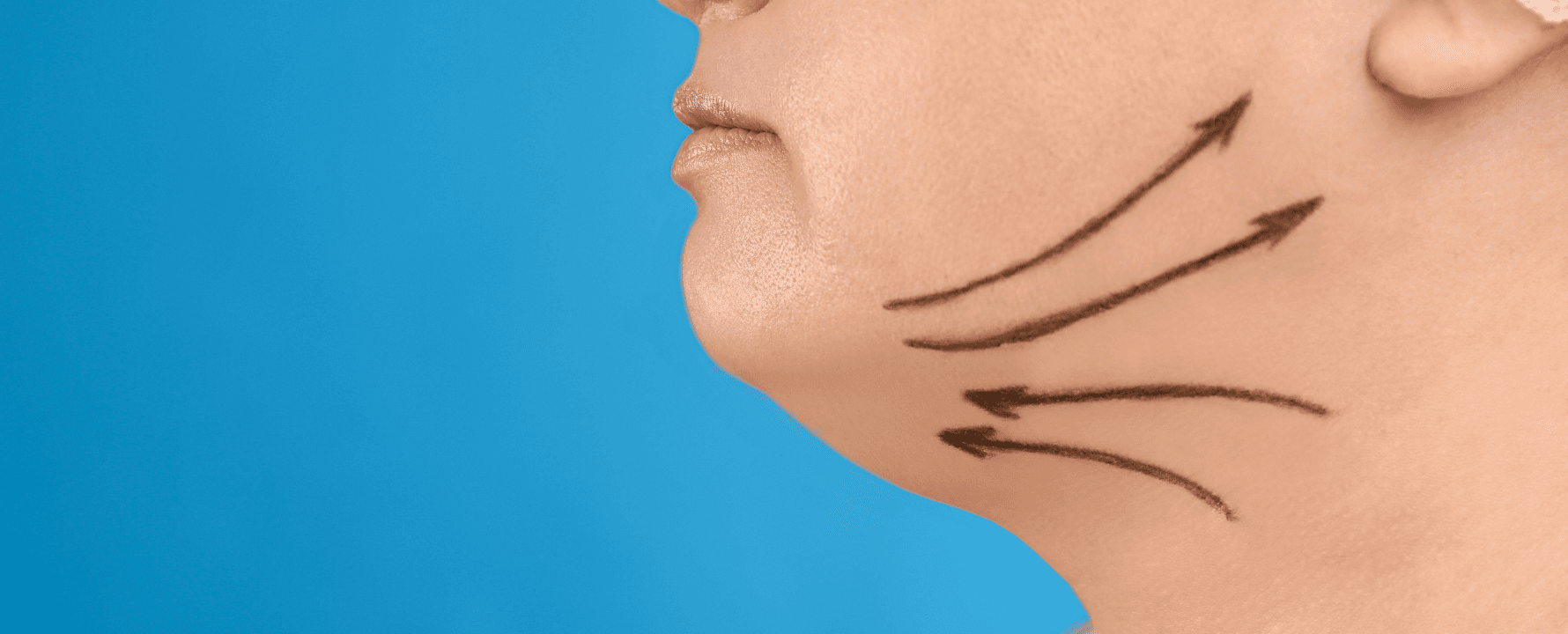 Lipoescultura de papada + Lipo injerto de mentón